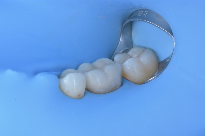 Onlay ceramic dupa