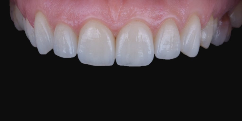 fatete dentare cluj