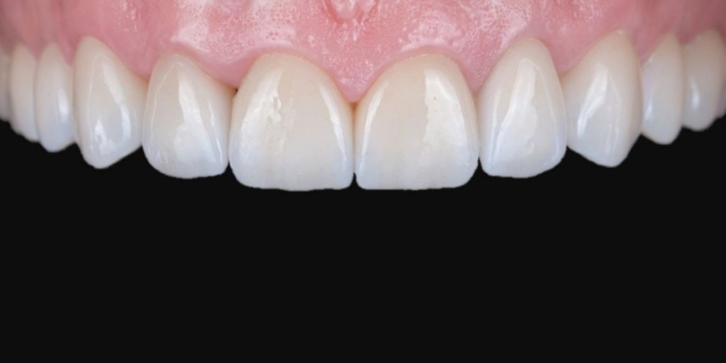 Corectare muscatura si dinti tociti prin fatete ceramice dupa