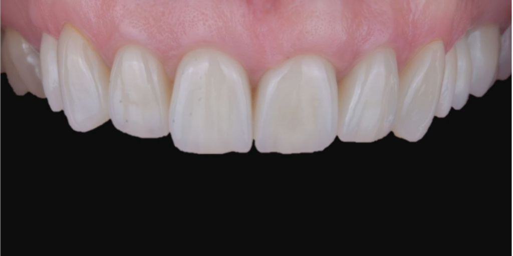Fatete dentare inainte si dupa