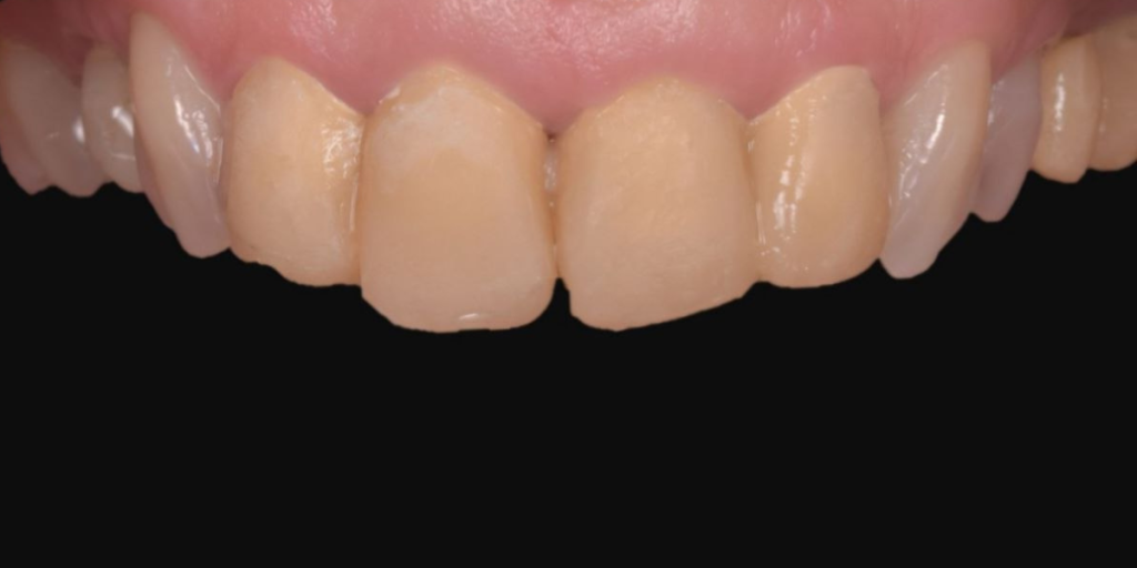 Fatete dentare inainte si dupa